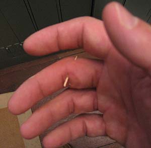 splinter through finger